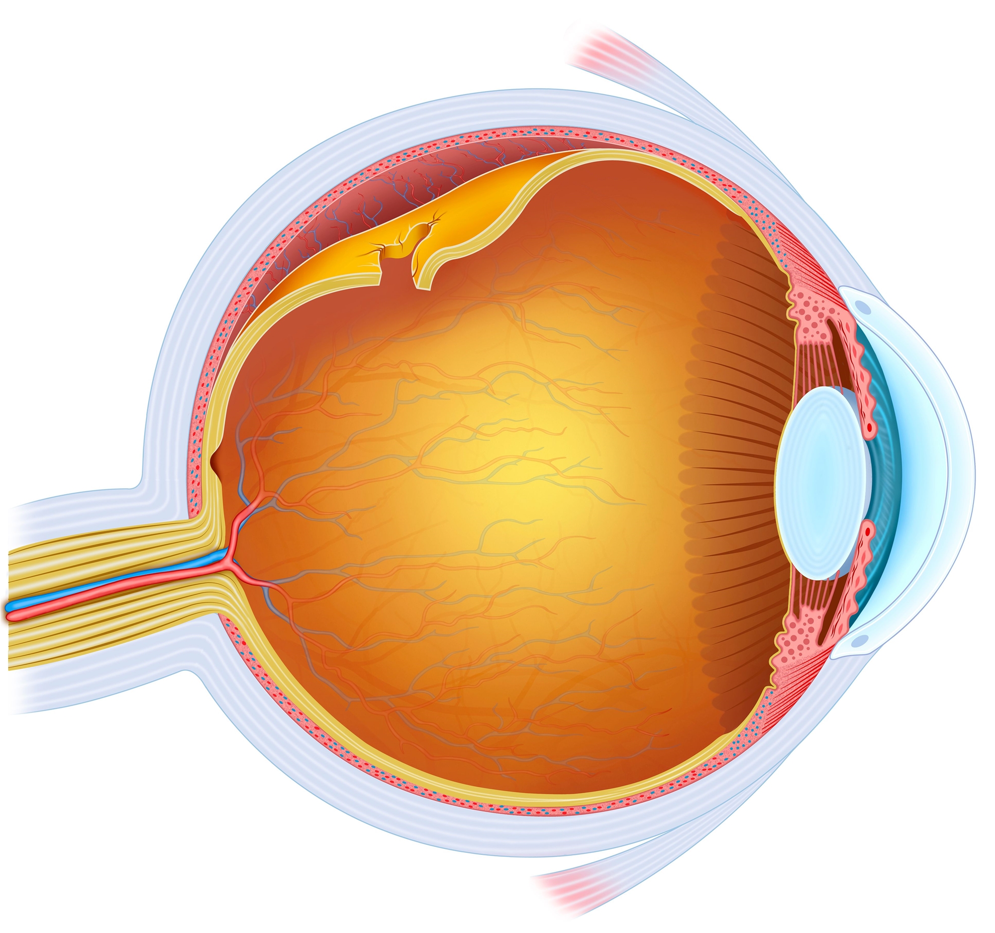 What Causes Retinal Detachment?