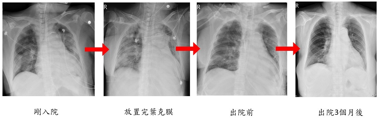 由左至右系列之胸部X光圖片可見,肺部雙側浸潤快速進展,經治療後逐漸消散