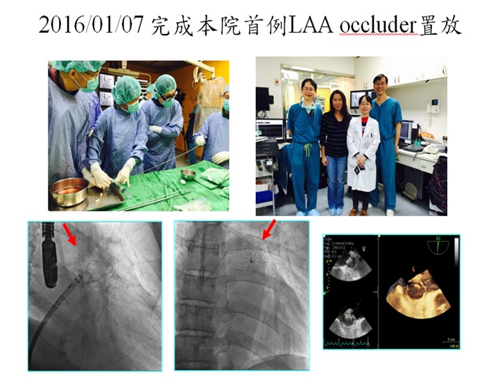 The Centre completed the first Left auricle closure procedure.