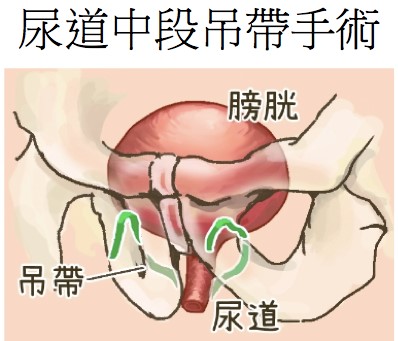 尿道中段吊帶手術