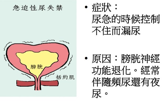 急迫性尿失禁