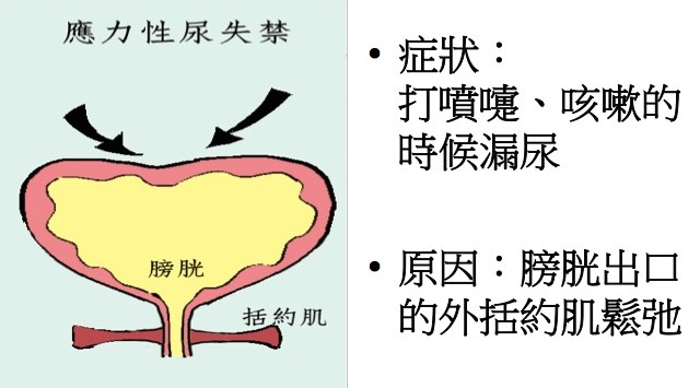 應力性尿失禁