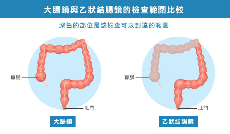 大腸鏡與乙狀結腸鏡的檢查範圍比較