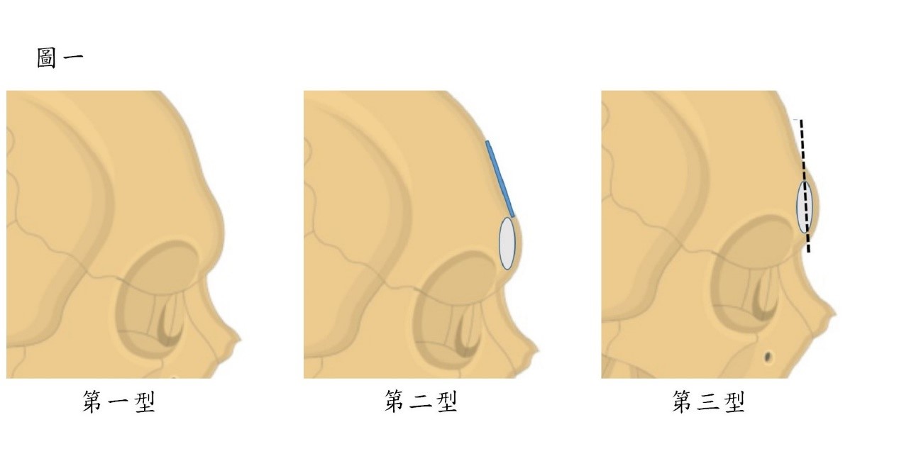 男性額骨的分類