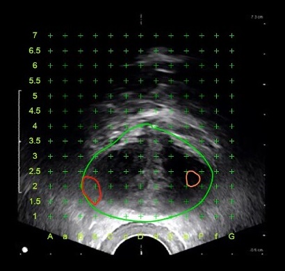 磁振造影與超音波影像融合的圖形，可建構攝護腺左右兩側各有一病灶