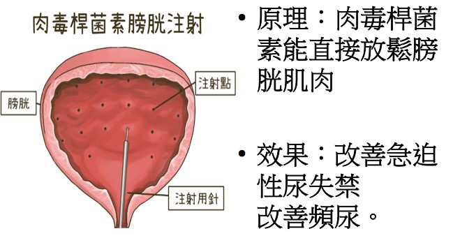 肉毒桿菌素膀胱注射