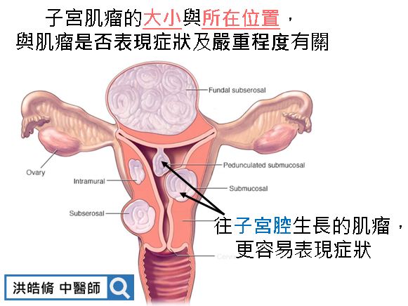 肌瘤大小與生長位置