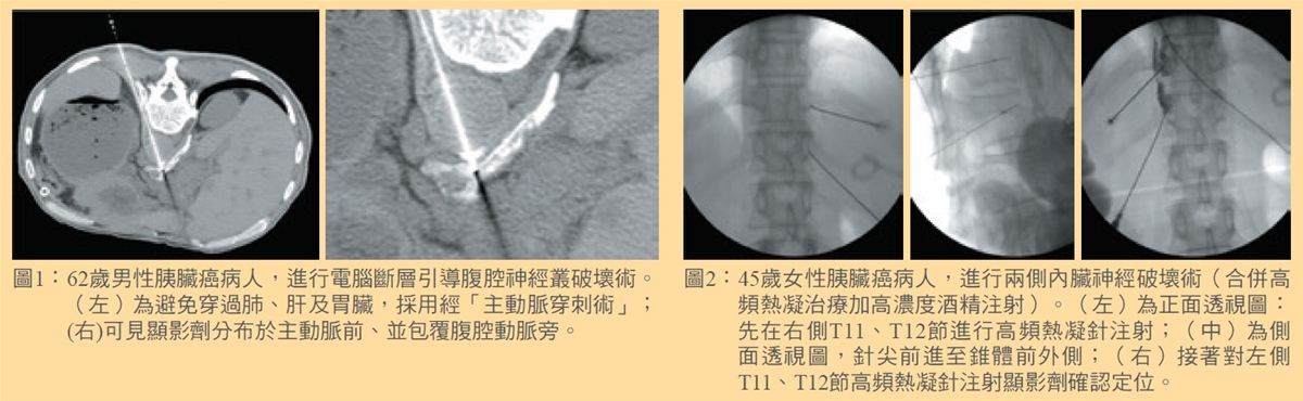 癌症的止痛大師 介入性疼痛治療