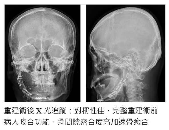 重建術後X光追蹤：對稱性佳、完整重建術前病人咬合功能、骨間隙密合度高加速骨癒合