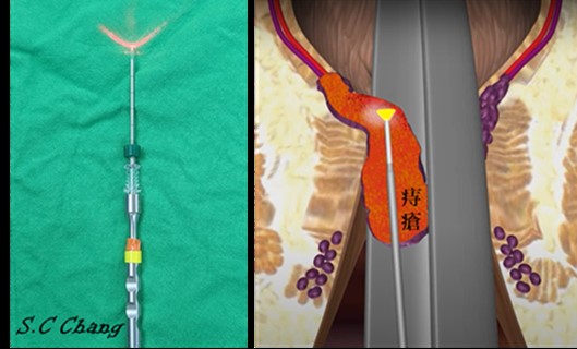 雙極雷射痔瘡手術(LHP) 真正的微創痔瘡手術治療