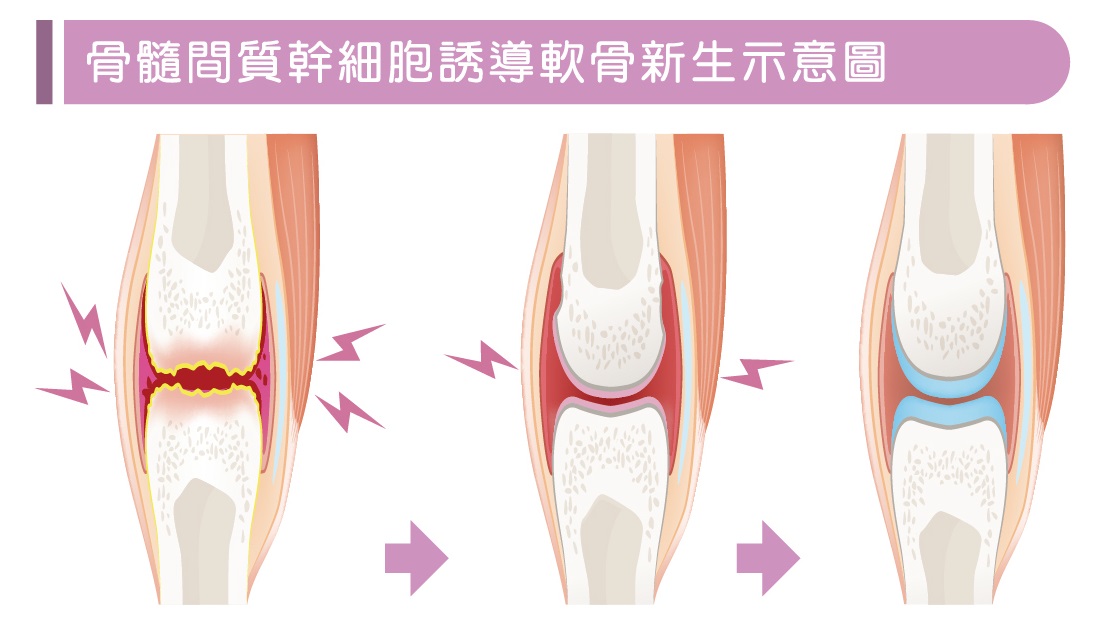 骨髓間質幹細胞誘導軟骨新生示意圖