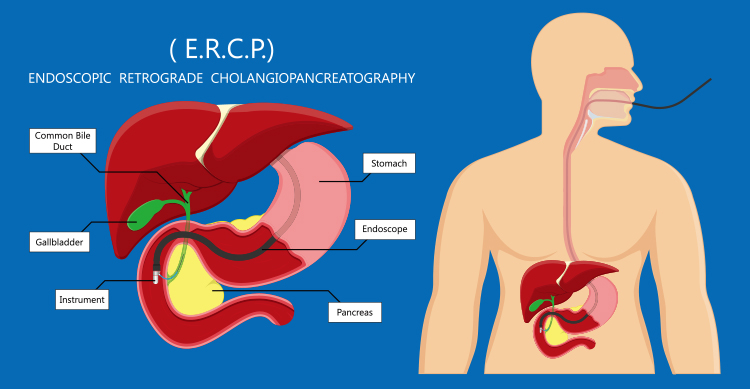 ERCP