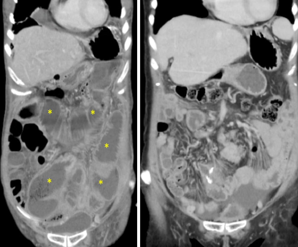 術前(圖左)影像星號標記部分為腸道因腫瘤壓迫阻塞進而造成腫脹，於術後三個月(圖右)發現腸道腫脹狀況已明顯緩解。
