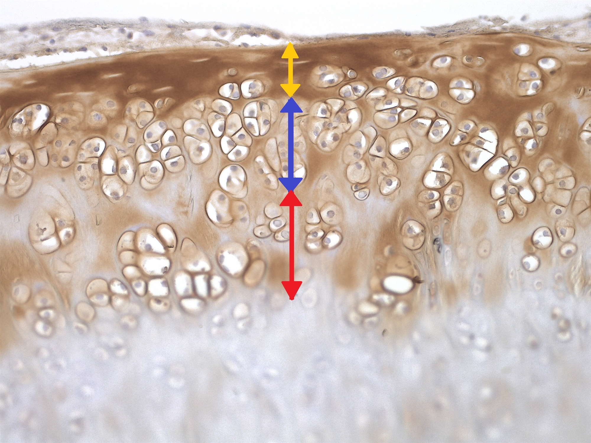 在大鼠的關節內多次注射雙功能肽(BiFP)遞送人類間質幹細胞，免疫組織化學檢測顯示棕色陽性信號處為新生的多層關節軟骨細胞，紅色、藍色、黃色分別為第一次、第二次、第三次施打的幹細胞。