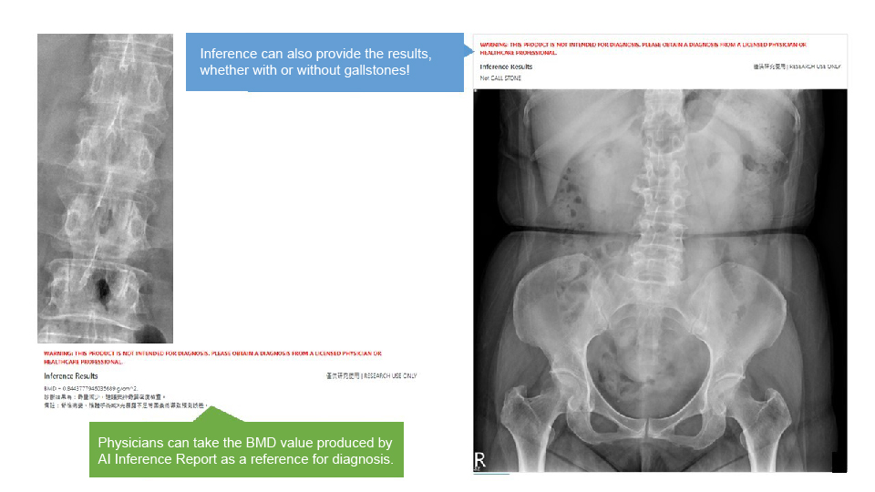 AI results generated by bone mineral density interpretation model