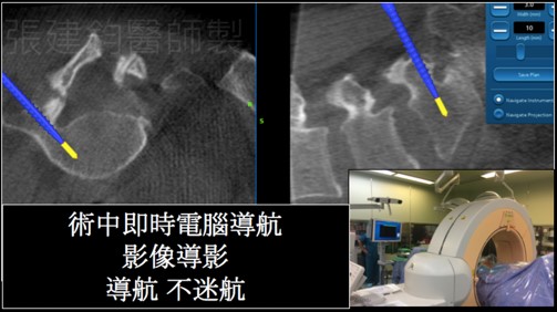 3D電腦導航脊椎手術