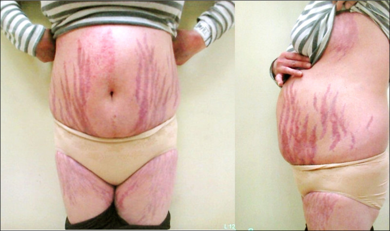 ▲圖1：患者的肚子及大腿出現暗紫色條紋。（照片提供／王子源）