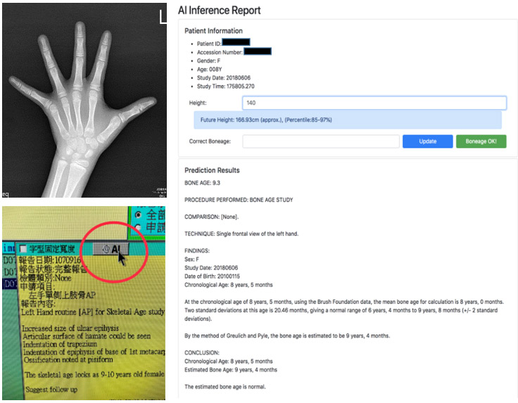 Bone age AI button and AI reports，providing assessment value of children’s bone age and height prediction