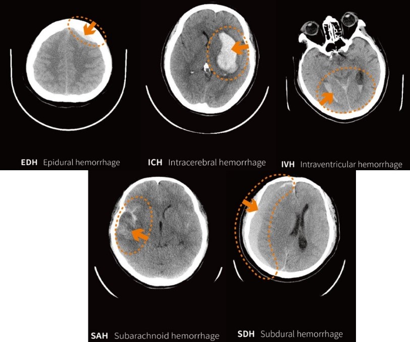 Capable to detect five types of ICH (EDH / SDH / SAH / ICH / IVH)