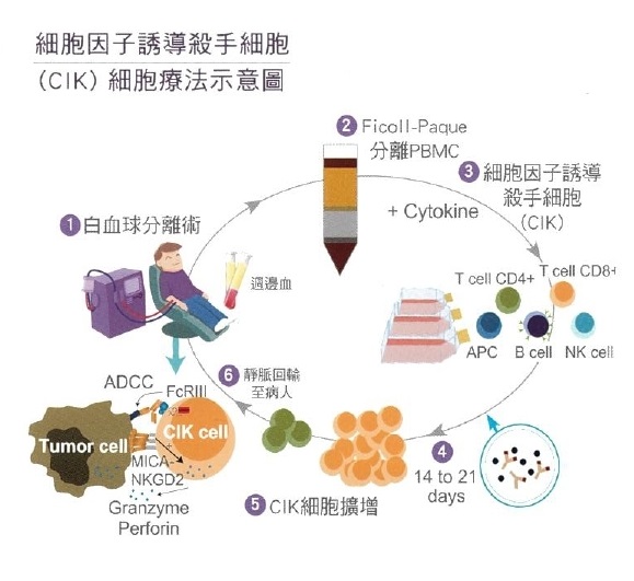 細胞因子誘導殺手細胞(CIK)細胞療法示意圖