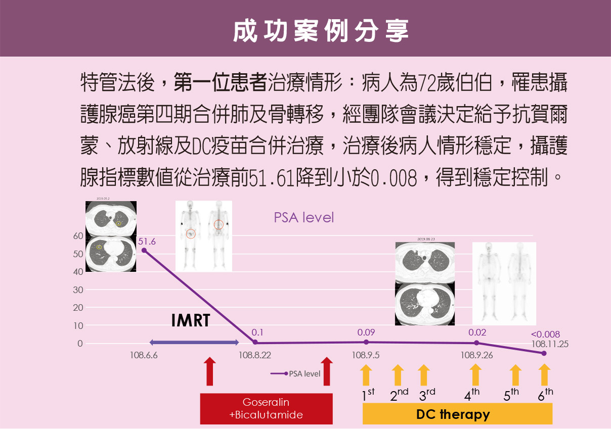 DC細胞治療攝護腺癌成功案例