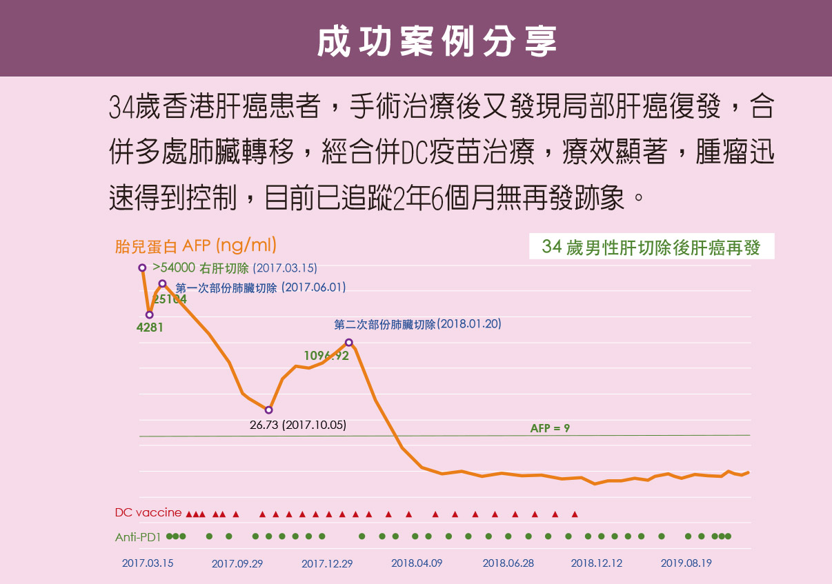 DC細胞治療肝癌成功案例