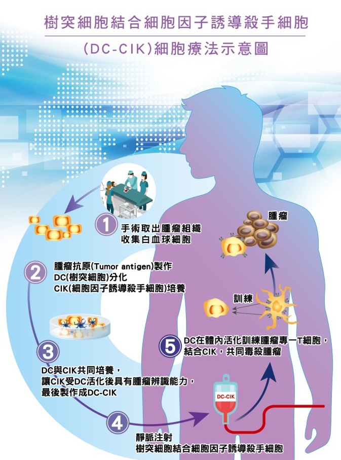 樹突細胞結合細胞因子誘導殺手細胞(DC-CIK) 細胞療法示意圖