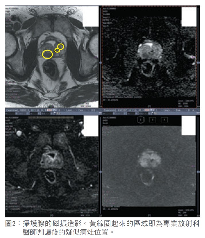 圖2：攝護腺的磁振造影。