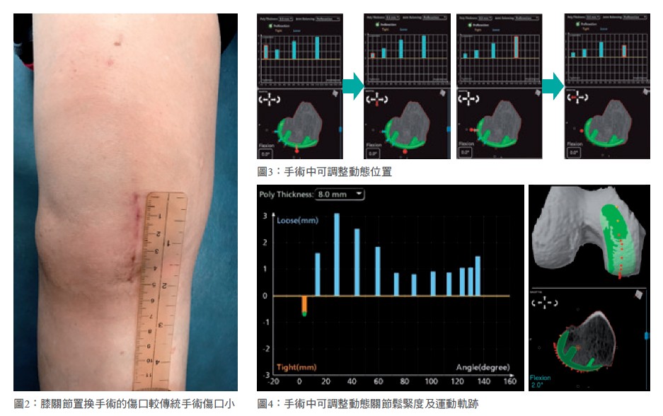 圖2：膝關節置換手術的傷口較傳統手術傷口小