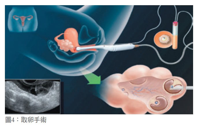 圖4：取卵手術