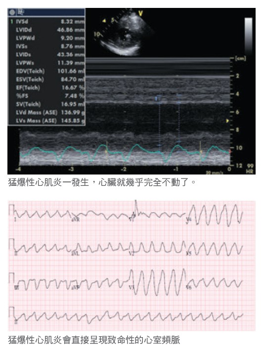 猛爆性心肌炎一發生，心臟就幾乎完全不動了。