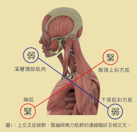 圖1：上交叉症候群，緊繃與無力肌群的連線剛好互相交叉。