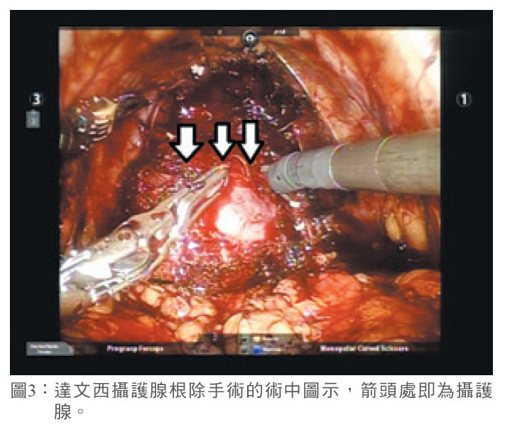 圖3： 達文西攝護腺根除手術的術中圖示