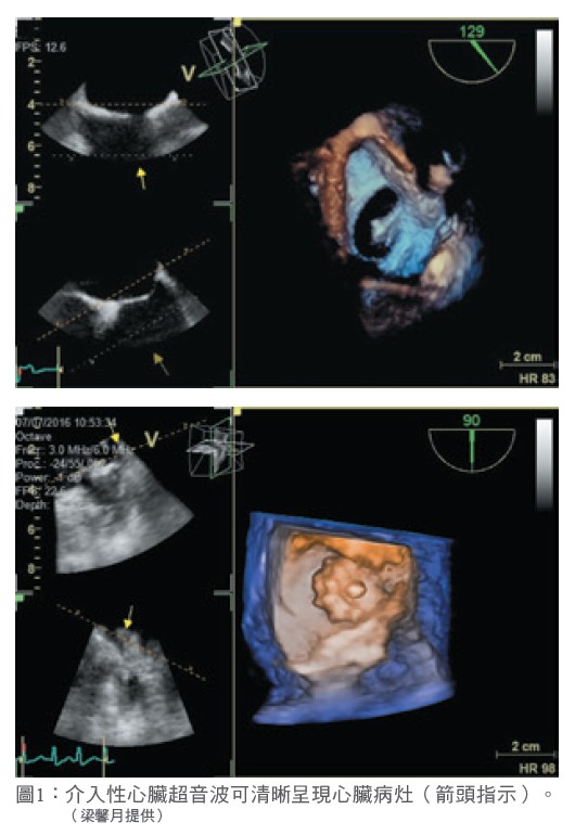 圖1： 介入性心臟超音波可清晰呈現心臟病灶（箭頭指示）。 （梁馨月提供）