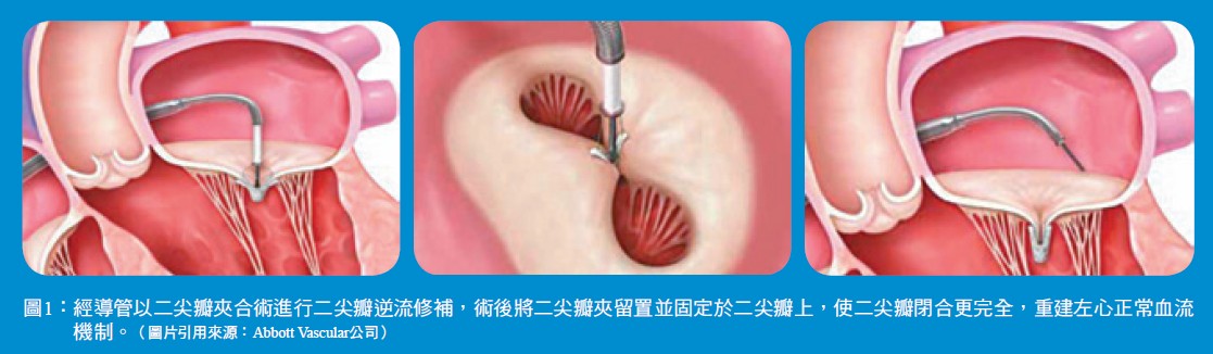 圖1： 經導管以二尖瓣夾合術進行二尖瓣逆流修補，術後將二尖瓣夾留置並固定於二尖瓣上，使二尖瓣閉合更完全，重建左心正常血流機制