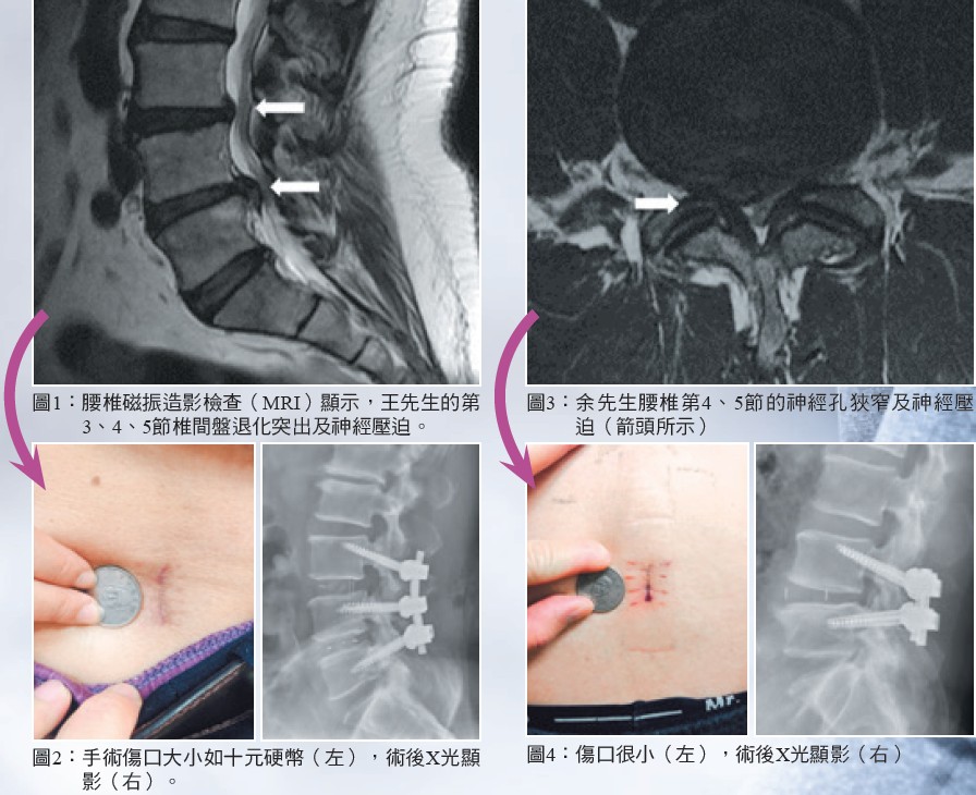 微切腰椎融合手術