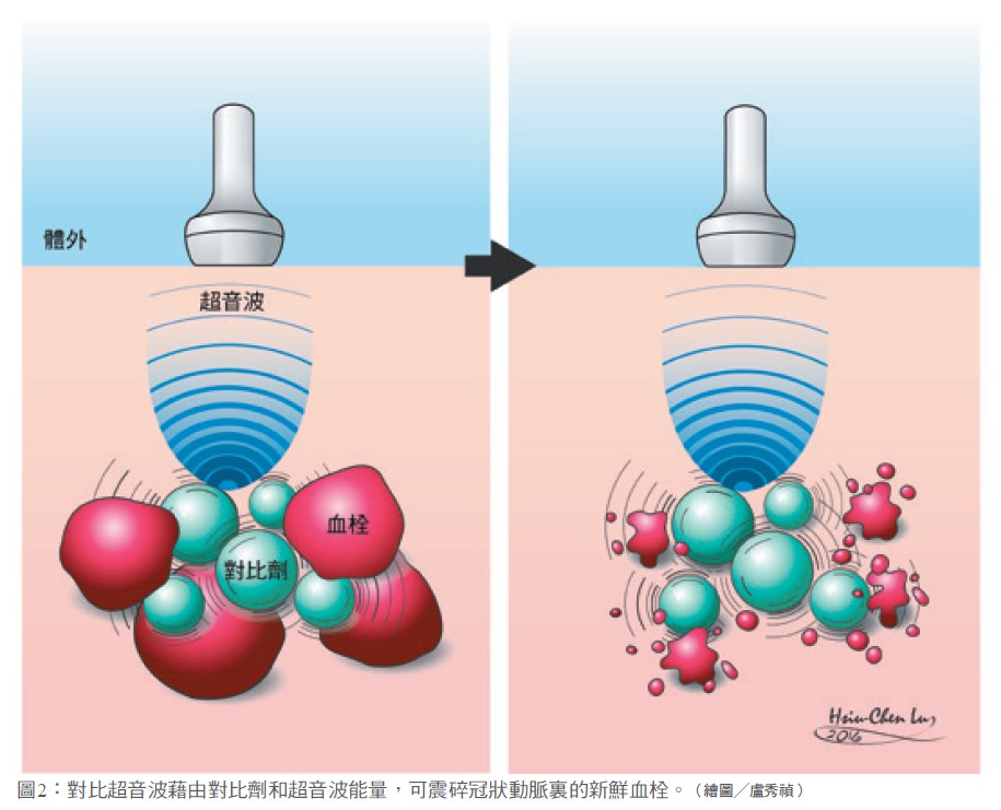 圖2：對比超音波藉由對比劑和超音波能量，可震碎冠狀動脈裏的新鮮血栓。（繪圖╱盧秀禎）