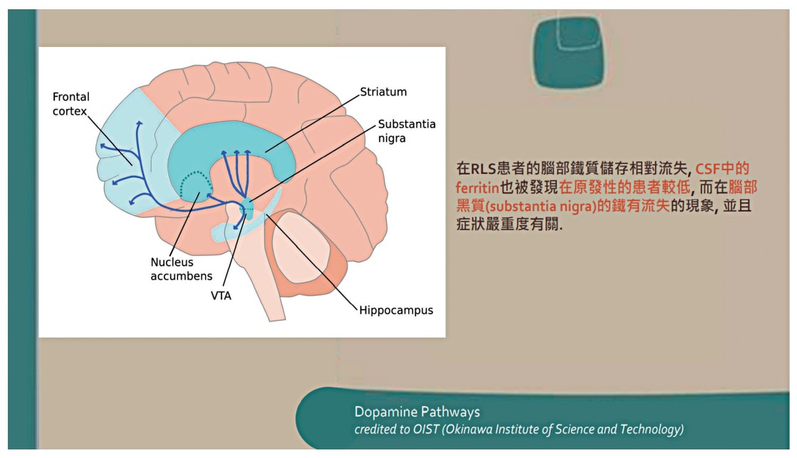 在RLS患者的腦部鐵質儲存相對流失