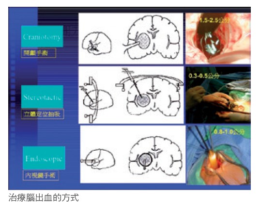 治療腦出血的方式