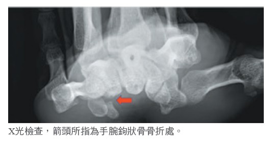 棒球選手的腕關節剋星鉤狀骨骨折與三角纖維軟骨複合體損傷 醫療新聞 中國醫藥大學附設醫院
