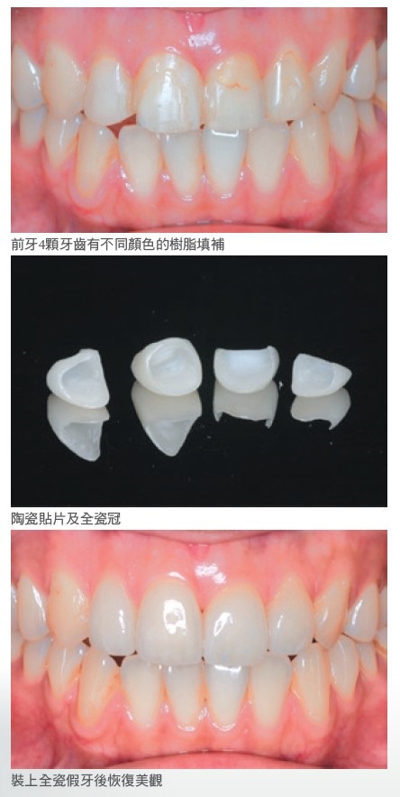 前牙4顆牙齒有不同顏色的樹脂填補