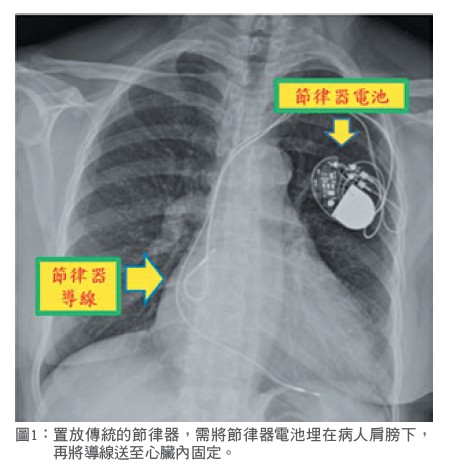 圖1： 置放傳統的節律器，需將節律器電池埋在病人肩膀下，再將導線送至心臟內固定。