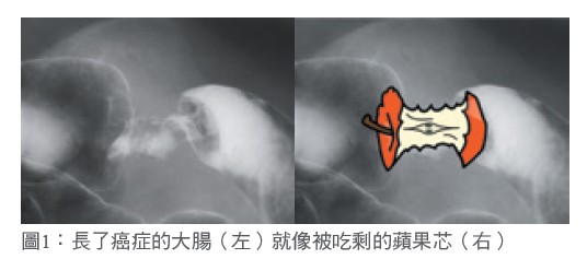 圖1：長了癌症的大腸（左）就像被吃剩的蘋果芯（右）