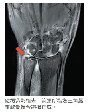 磁振造影檢查，箭頭所指為三角纖維軟骨複合體損傷處