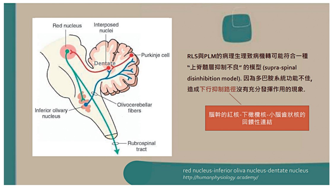 RLS與PLM的病理生理致病機轉可能符合上脊髓層控制不良的模型