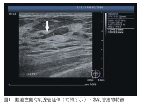 圖1：腫瘤左側有乳腺管延伸（箭頭所示），為乳管瘤的特徵。