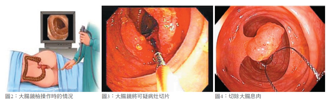 圖2：大腸鏡檢操作時的情況