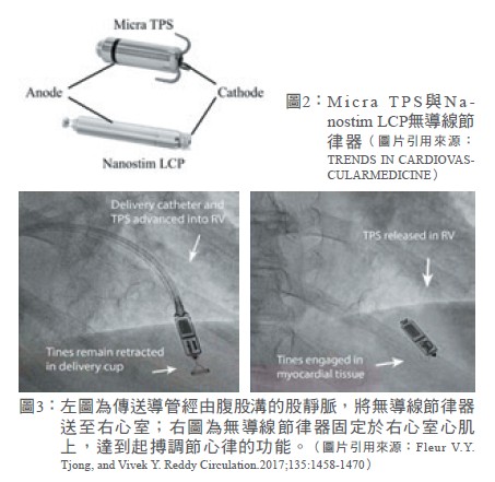 圖2：M icra TPS與Nanostim LCP無導線節律器