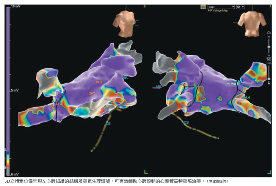 3D立體定位儀呈現左心房細緻的結構及電氣生理訊號，可有效輔助心房顫動的心導管高頻電燒治療。（陳建佑提供）