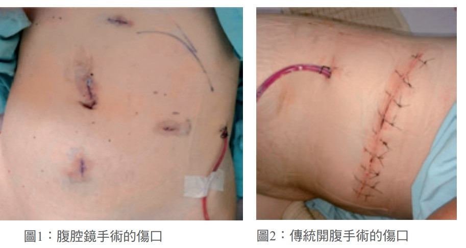 圖1：腹腔鏡手術的傷口